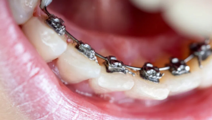 lingual braces